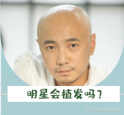 揭秘明星不植发的背后原因,温情与陪伴的秀发故事